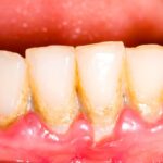 Is White Spot on Gums Bad? Understanding Dental Discoloration