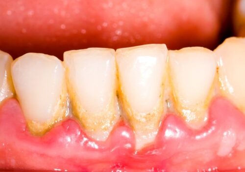 Is White Spot on Gums Bad? Understanding Dental Discoloration